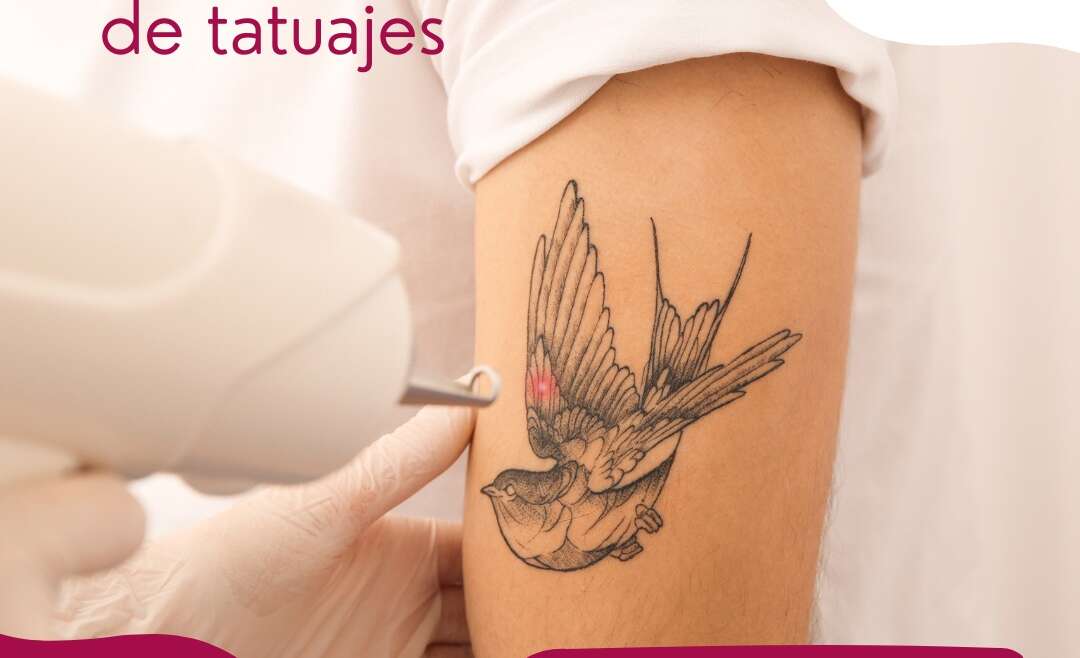 Eliminación de tatuaje